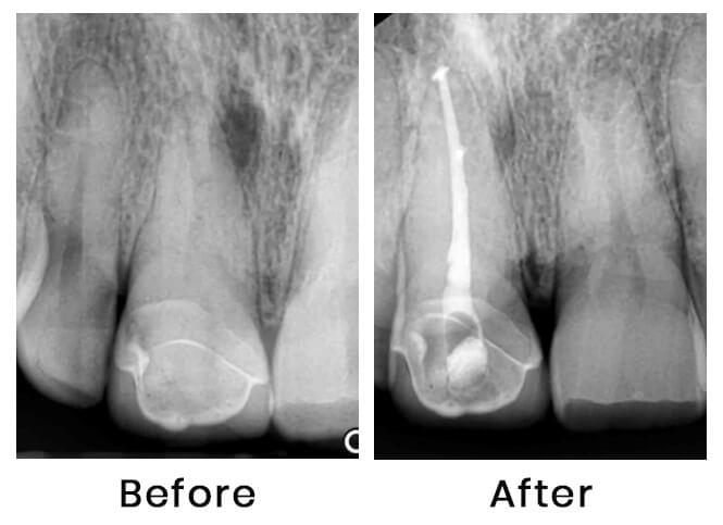 Does your tooth need a root canal treatment?