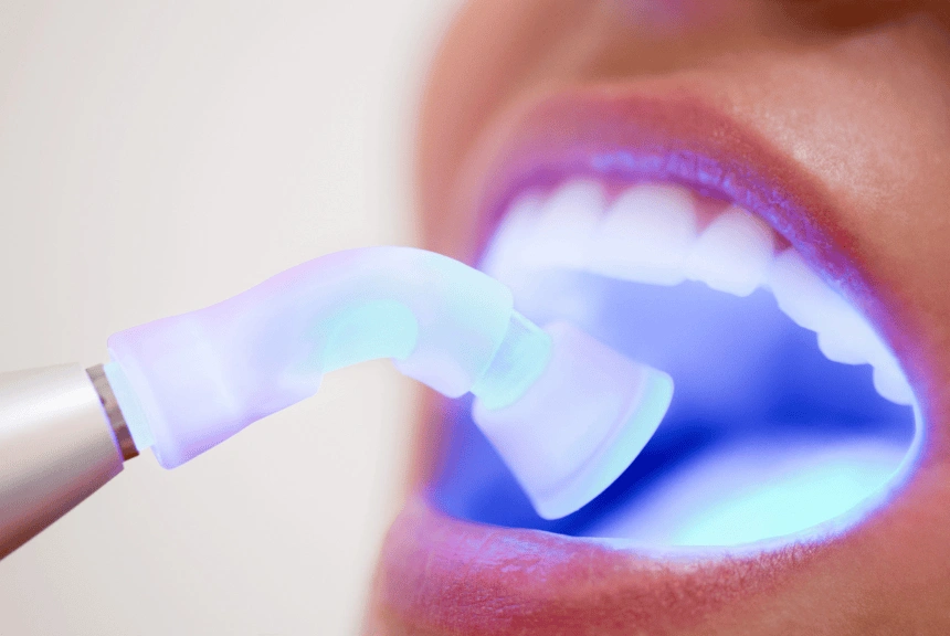 Composite Fillings in Coquitlam, BC