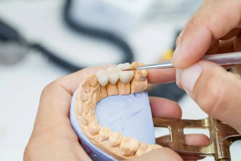 Dental Bridges in Coquitlam, BC