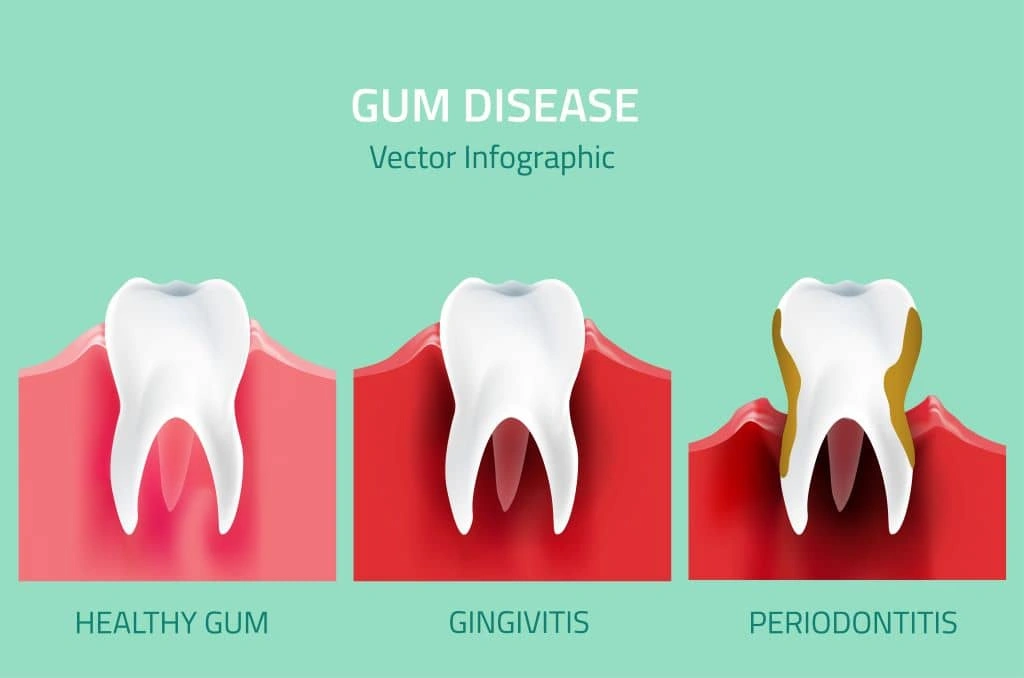 Periodontal Treatment in Coquitlam, BC