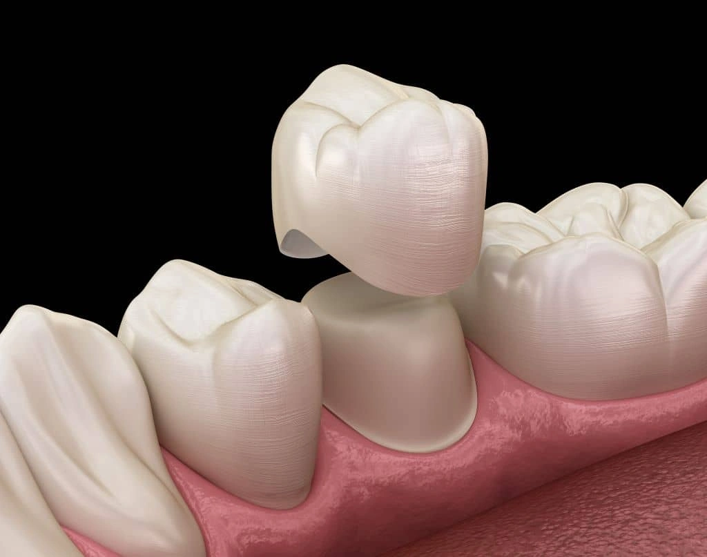 Porcelain Crowns in Coquitlam, BC