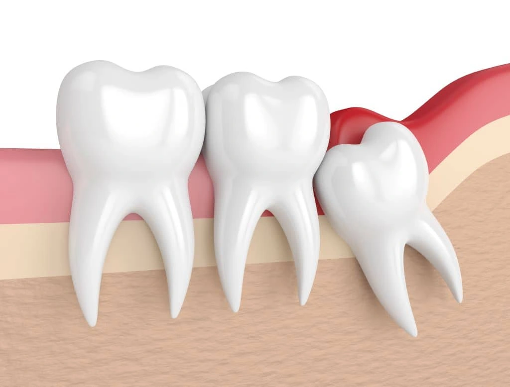 Wisdom Tooth Removal in Coquitlam, BC