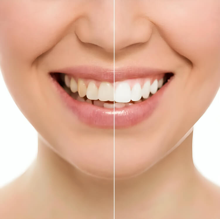 "Zoom In-Office Teeth Whitening at $399 at Lincoln Dental Center"
