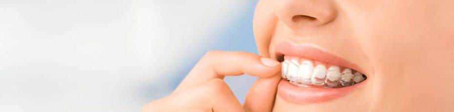 Are Invisalign Aligners As Effective As Braces?