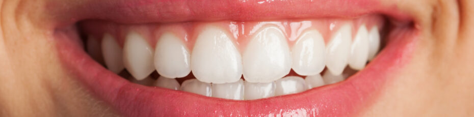 how long does teeth whitening last